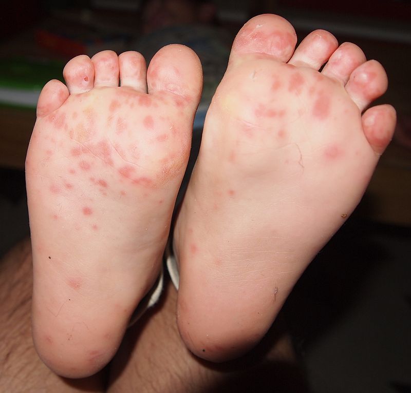 Kéz-láb-száj betegség: okok, tünetek, kezelés