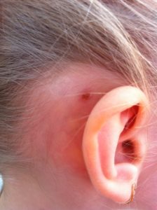 Bárányhimlős tünet: beszáradt kiütés a fül mögött