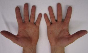 Kéz-láb-száj betegség: kiütések a kézen