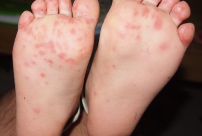 Kéz-láb-száj betegség: kiütések a lábikón